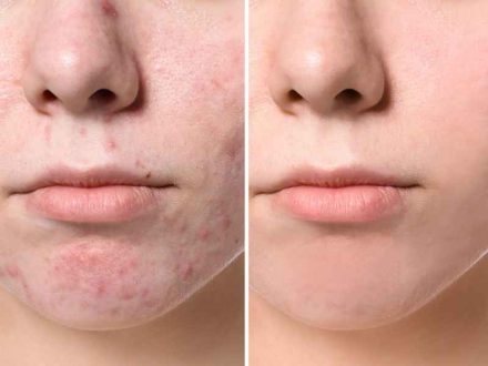 کرم آنتی آکنه (ضد جوش) ژوت40میلی لیتر